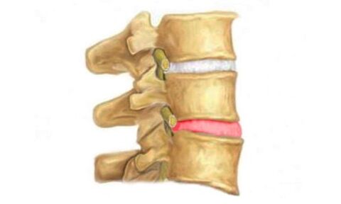 Изпъкналост на междупрешленния диск на гръбначния стълб - признак на остеохондроза