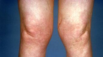 деформация на коленните стави с артроза