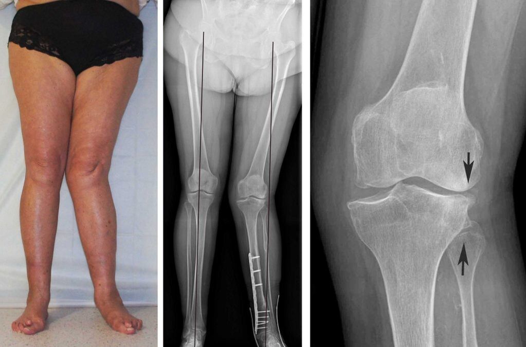 клинична картина на артроза на коляното