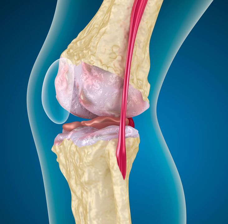 Артроза на колянната става - дегенеративно-дистрофично заболяване