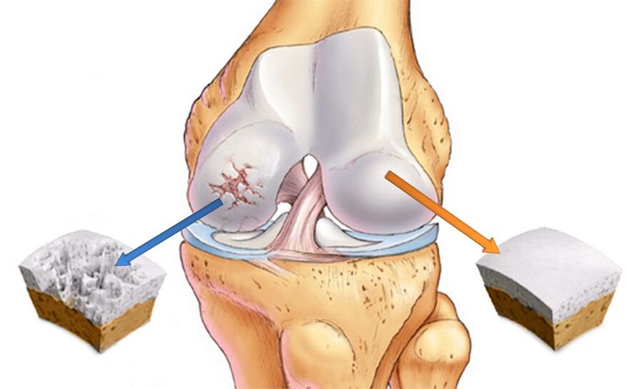 Здрава колянна става (вдясно) и засегната от артроза (вляво)