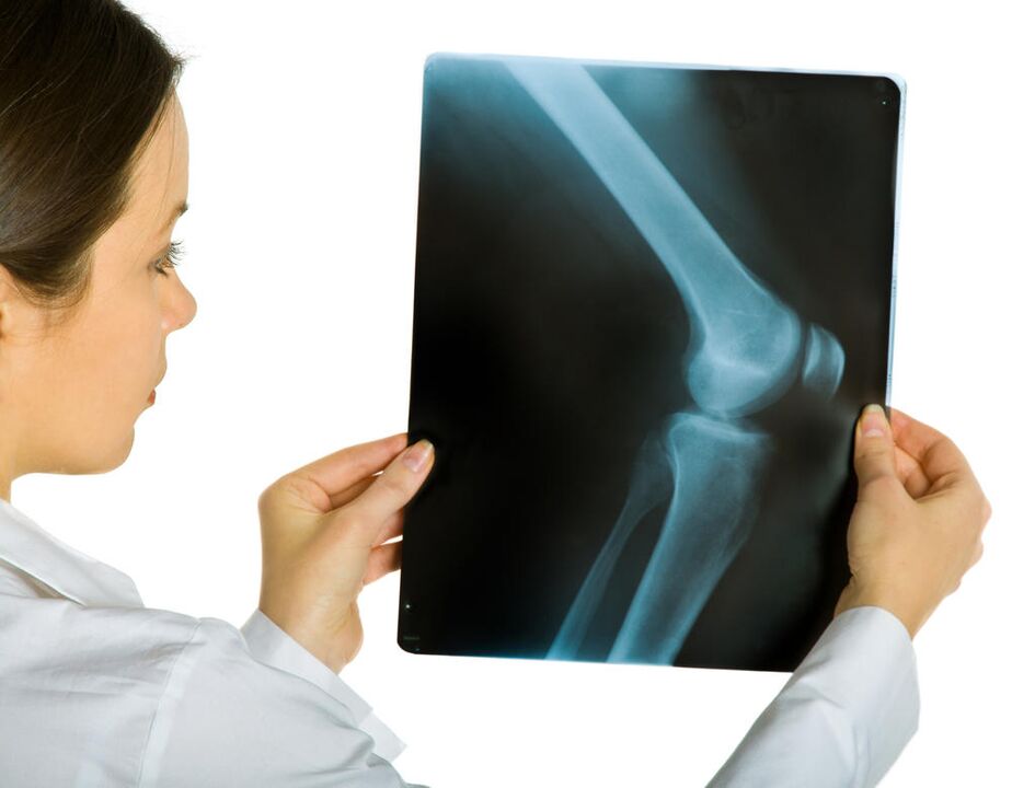 Рентгенографията на колянната става ще разкрие наличието на деформираща артроза